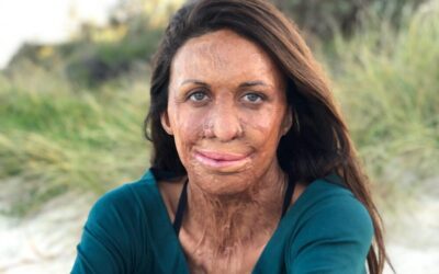 Turia Pitt: How to rewrite your own story